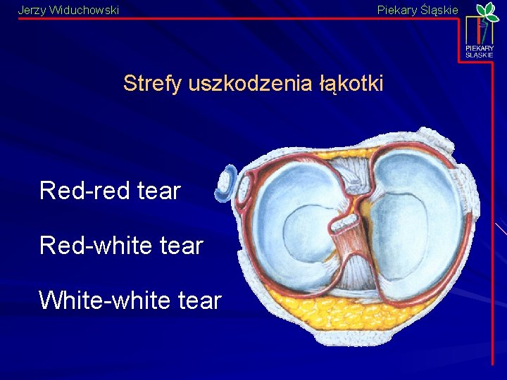 Jerzy Widuchowski Piekary Śląskie Strefy uszkodzenia łąkotki Red-red tear Red-white tear White-white tear 