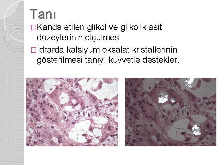 Tanı �Kanda etilen glikol ve glikolik asit düzeylerinin ölçülmesi �İdrarda kalsiyum oksalat kristallerinin gösterilmesi