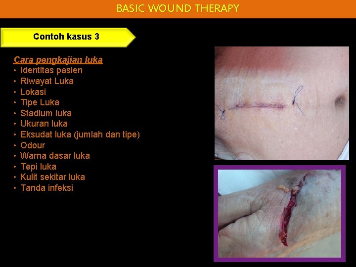 BASIC WOUND THERAPY Contoh kasus 3 Cara pengkajian luka • Identitas pasien • Riwayat