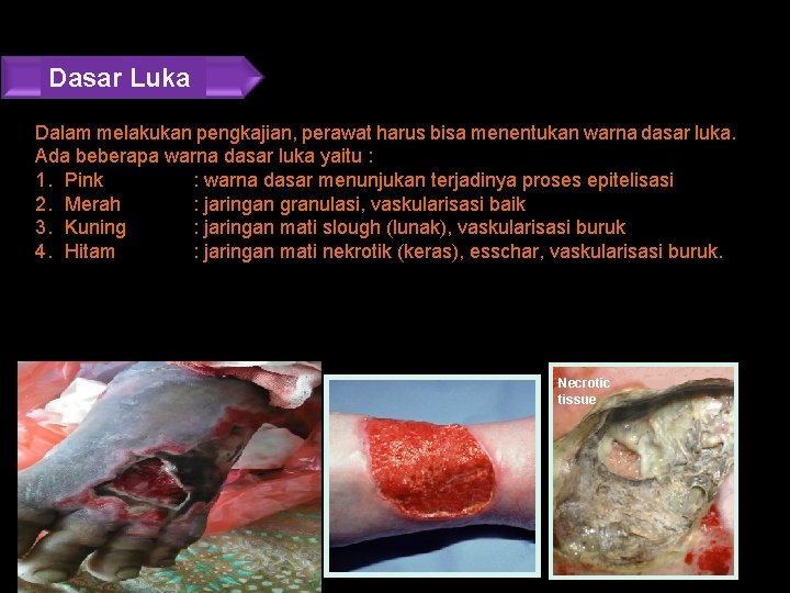 Dasar Luka Dalam melakukan pengkajian, perawat harus bisa menentukan warna dasar luka. Ada beberapa