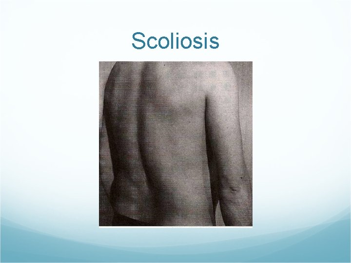 Scoliosis 