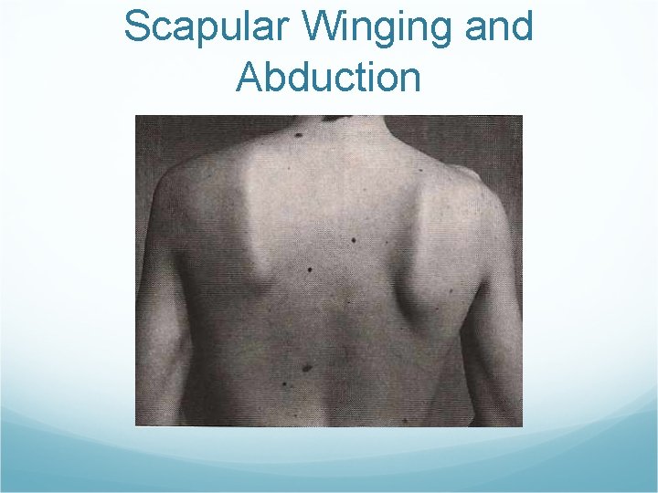 Scapular Winging and Abduction 