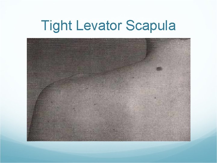 Tight Levator Scapula 