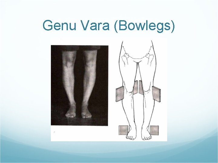 Genu Vara (Bowlegs) 