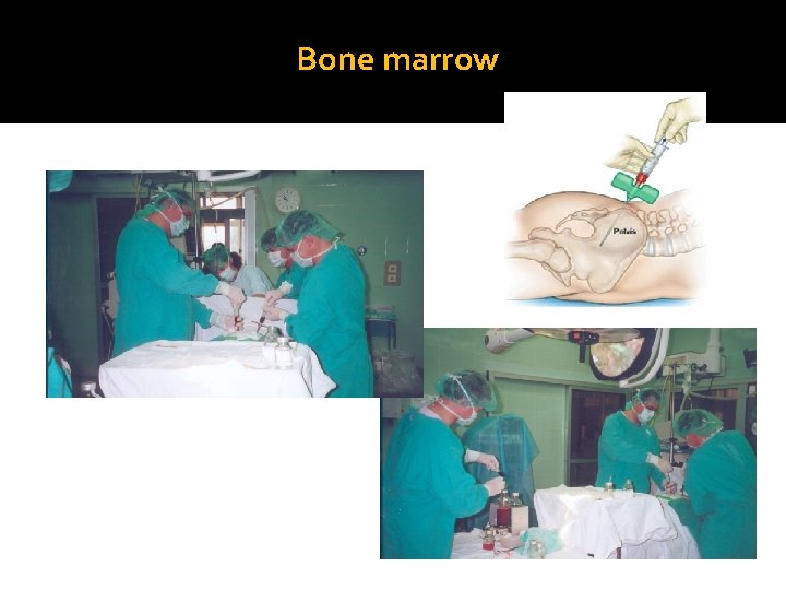 Bone marrow 