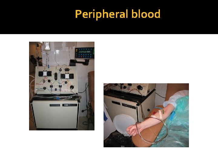 Peripheral blood 