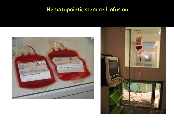 Hematopoietic stem cell infusion 