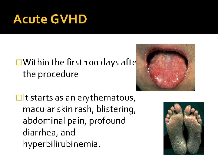 Acute GVHD �Within the first 100 days after the procedure �It starts as an