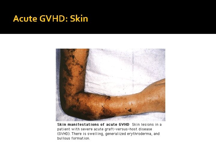 Acute GVHD: Skin 