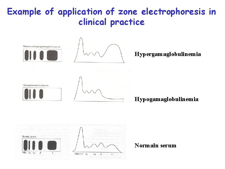 Example of application of zone electrophoresis in clinical practice Hypergamaglobulinemia Hypogamaglobulinemia Normaln serum 