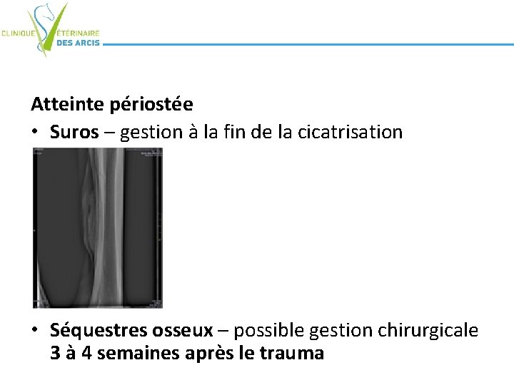 Atteinte périostée • Suros – gestion à la fin de la cicatrisation • Séquestres Atteinte périostée • Suros – gestion à la fin de la cicatrisation • Séquestres