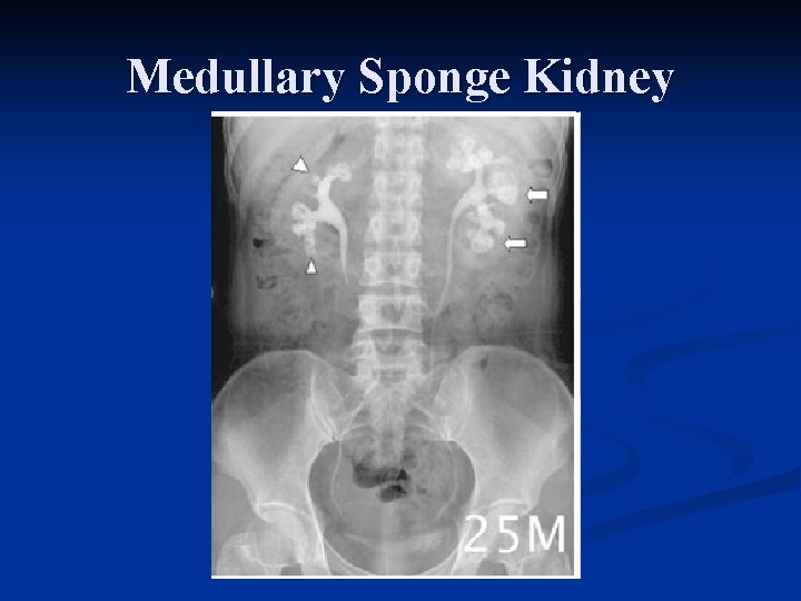 Medullary Sponge Kidney 