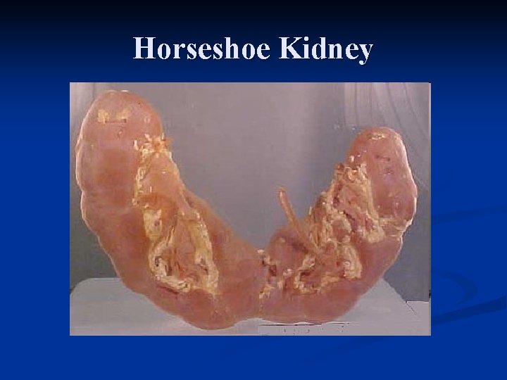 Horseshoe Kidney 