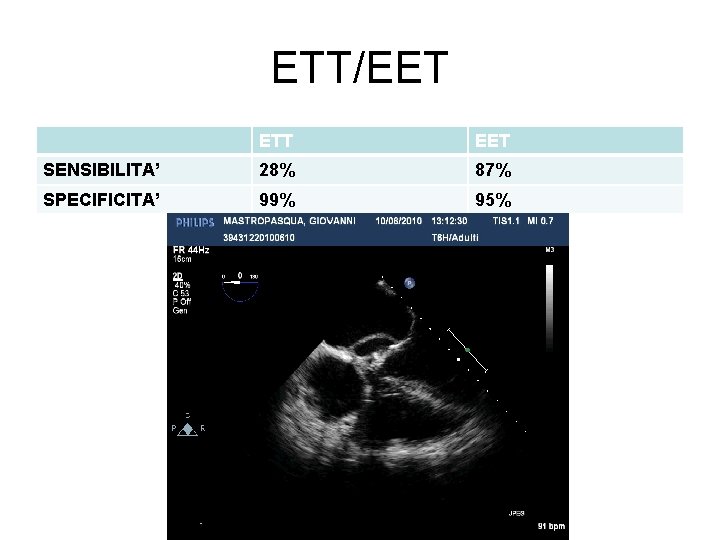 ETT/EET ETT EET SENSIBILITA’ 28% 87% SPECIFICITA’ 99% 95% 