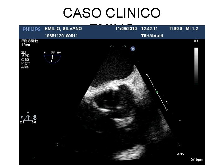 CASO CLINICO EMILIO 