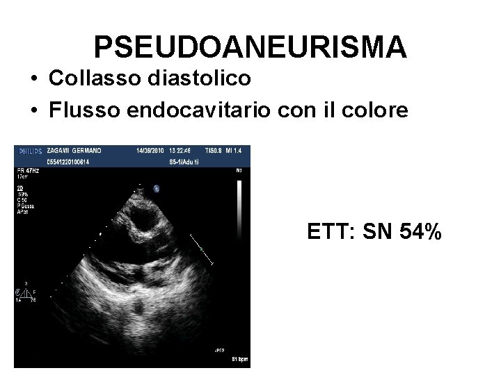 PSEUDOANEURISMA • Collasso diastolico • Flusso endocavitario con il colore ETT: SN 54% 