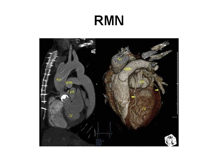 RMN 