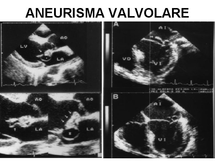 ANEURISMA VALVOLARE 