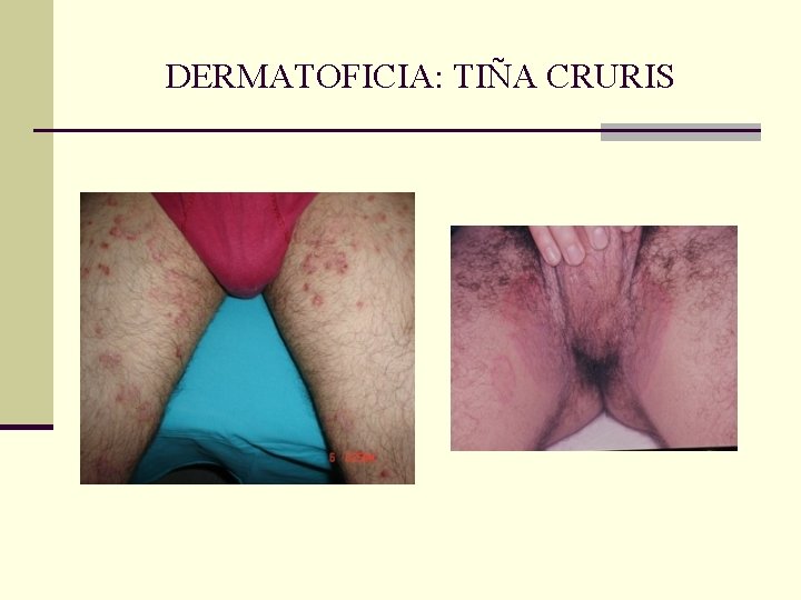 DERMATOFICIA: TIÑA CRURIS DERMATOFICIA: TIÑA CRURIS