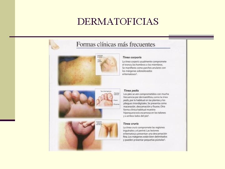 DERMATOFICIAS DERMATOFICIAS