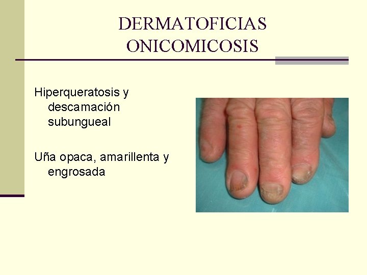 DERMATOFICIAS ONICOMICOSIS Hiperqueratosis y descamación subungueal Uña opaca, amarillenta y engrosada DERMATOFICIAS ONICOMICOSIS Hiperqueratosis y descamación subungueal Uña opaca, amarillenta y engrosada