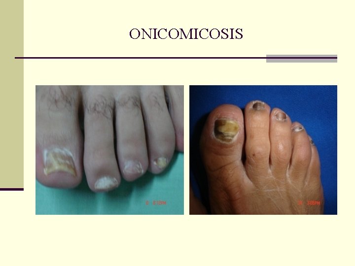 ONICOMICOSIS ONICOMICOSIS
