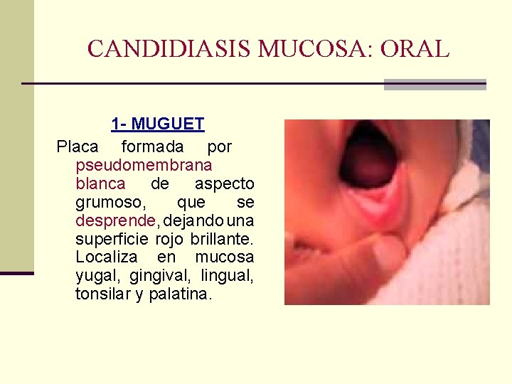 CANDIDIASIS MUCOSA: ORAL 1 - MUGUET Placa formada por pseudomembrana blanca de aspecto grumoso, CANDIDIASIS MUCOSA: ORAL 1 - MUGUET Placa formada por pseudomembrana blanca de aspecto grumoso,