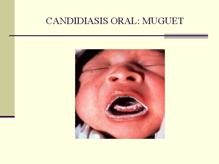 CANDIDIASIS ORAL: MUGUET CANDIDIASIS ORAL: MUGUET