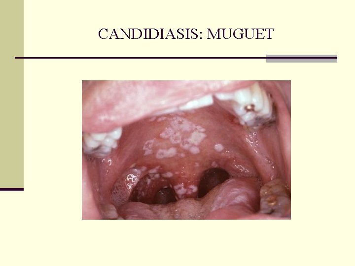 CANDIDIASIS: MUGUET CANDIDIASIS: MUGUET