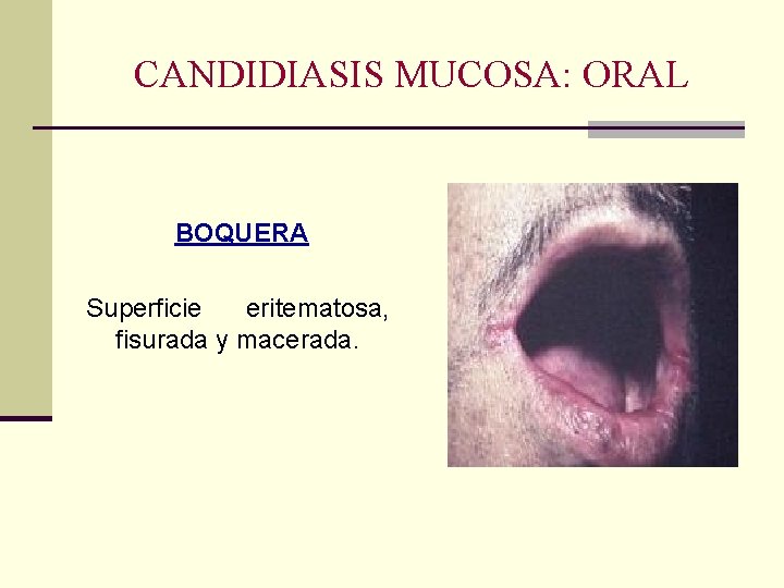 CANDIDIASIS MUCOSA: ORAL BOQUERA Superficie eritematosa, fisurada y macerada. CANDIDIASIS MUCOSA: ORAL BOQUERA Superficie eritematosa, fisurada y macerada.