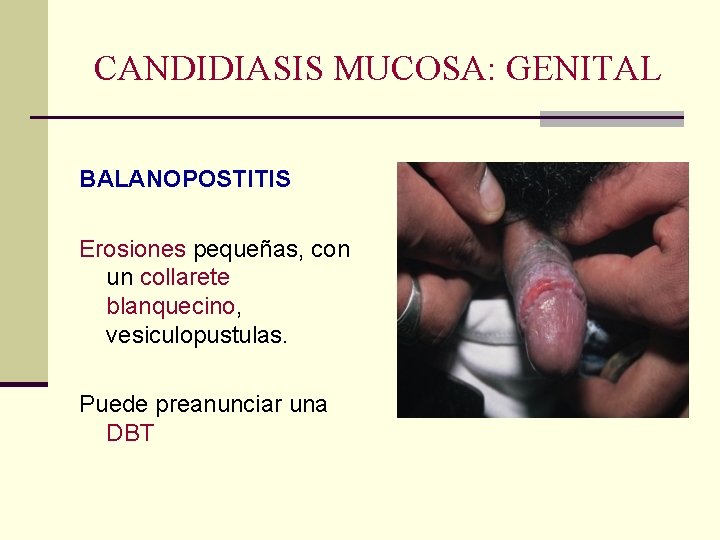 CANDIDIASIS MUCOSA: GENITAL BALANOPOSTITIS Erosiones pequeñas, con un collarete blanquecino, vesiculopustulas. Puede preanunciar una CANDIDIASIS MUCOSA: GENITAL BALANOPOSTITIS Erosiones pequeñas, con un collarete blanquecino, vesiculopustulas. Puede preanunciar una