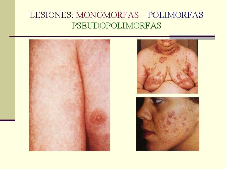 LESIONES: MONOMORFAS – POLIMORFAS PSEUDOPOLIMORFAS LESIONES: MONOMORFAS – POLIMORFAS PSEUDOPOLIMORFAS