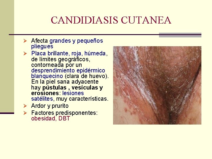 CANDIDIASIS CUTANEA Ø Afecta grandes y pequeños pliegues Ø Placa brillante, roja, húmeda, de CANDIDIASIS CUTANEA Ø Afecta grandes y pequeños pliegues Ø Placa brillante, roja, húmeda, de