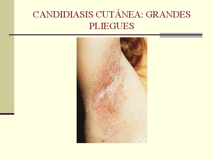 CANDIDIASIS CUTÁNEA: GRANDES PLIEGUES CANDIDIASIS CUTÁNEA: GRANDES PLIEGUES