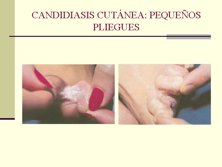 CANDIDIASIS CUTÁNEA: PEQUEÑOS PLIEGUES CANDIDIASIS CUTÁNEA: PEQUEÑOS PLIEGUES