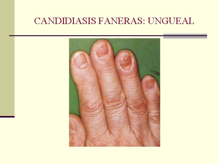 CANDIDIASIS FANERAS: UNGUEAL CANDIDIASIS FANERAS: UNGUEAL