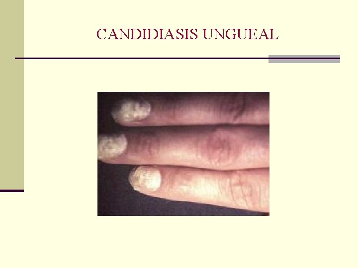 CANDIDIASIS UNGUEAL CANDIDIASIS UNGUEAL