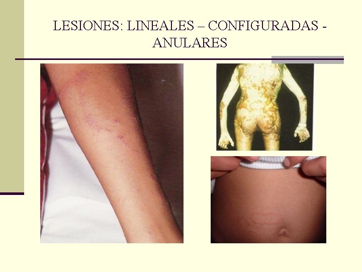 LESIONES: LINEALES – CONFIGURADAS ANULARES LESIONES: LINEALES – CONFIGURADAS ANULARES