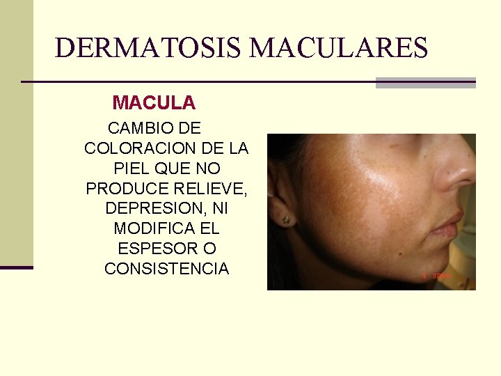 DERMATOSIS MACULARES MACULA CAMBIO DE COLORACION DE LA PIEL QUE NO PRODUCE RELIEVE, DEPRESION, DERMATOSIS MACULARES MACULA CAMBIO DE COLORACION DE LA PIEL QUE NO PRODUCE RELIEVE, DEPRESION,