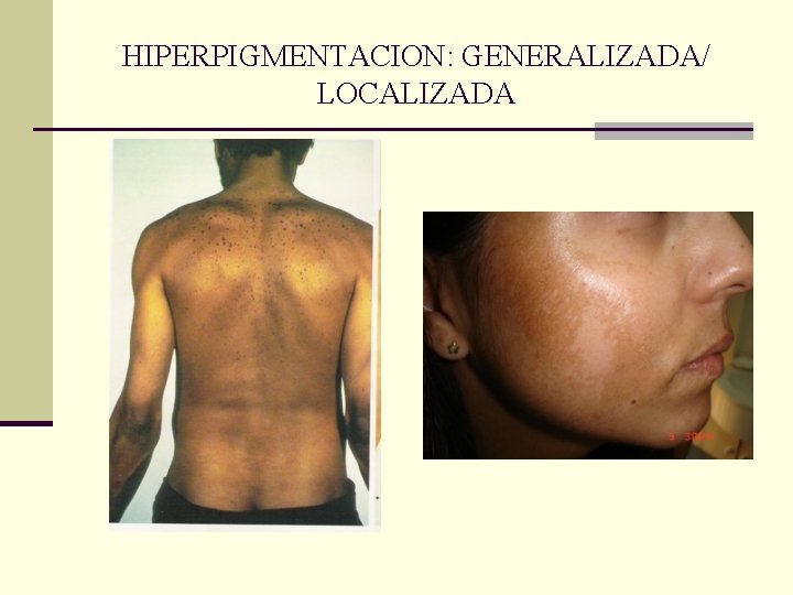 HIPERPIGMENTACION: GENERALIZADA/ LOCALIZADA HIPERPIGMENTACION: GENERALIZADA/ LOCALIZADA