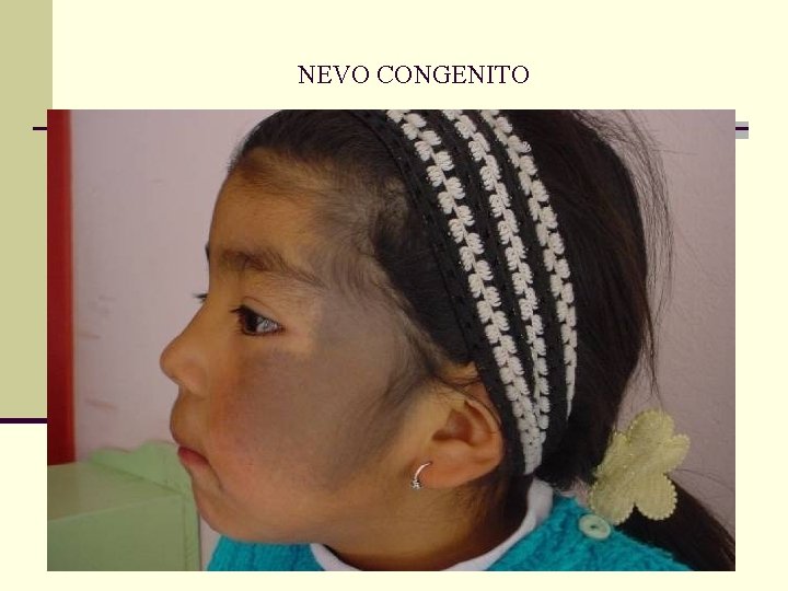 NEVO CONGENITO NEVO CONGENITO