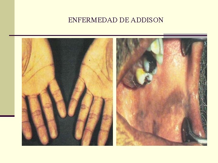 ENFERMEDAD DE ADDISON ENFERMEDAD DE ADDISON