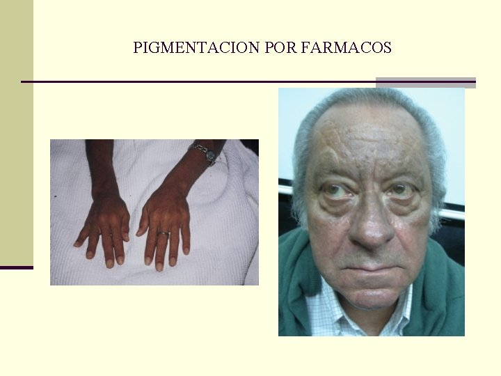 PIGMENTACION POR FARMACOS PIGMENTACION POR FARMACOS