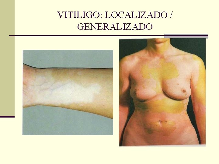 VITILIGO: LOCALIZADO / GENERALIZADO VITILIGO: LOCALIZADO / GENERALIZADO