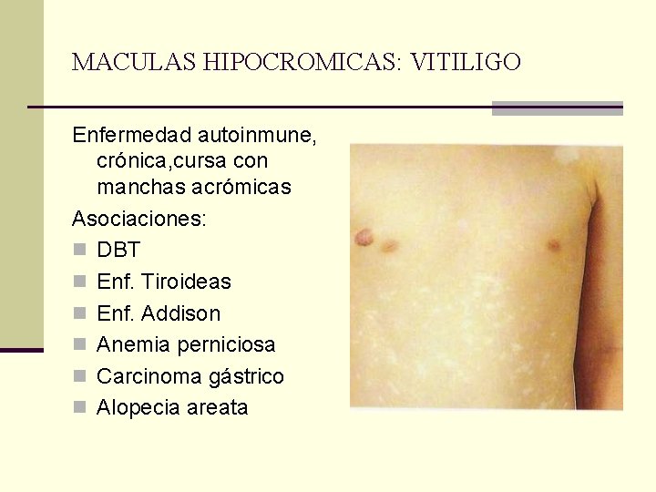 MACULAS HIPOCROMICAS: VITILIGO Enfermedad autoinmune, crónica, cursa con manchas acrómicas Asociaciones: n DBT n MACULAS HIPOCROMICAS: VITILIGO Enfermedad autoinmune, crónica, cursa con manchas acrómicas Asociaciones: n DBT n