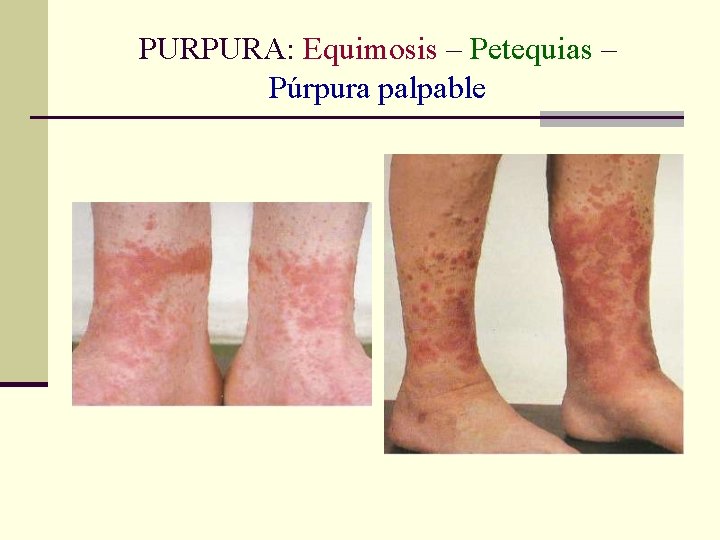 PURPURA: Equimosis – Petequias – Púrpura palpable PURPURA: Equimosis – Petequias – Púrpura palpable