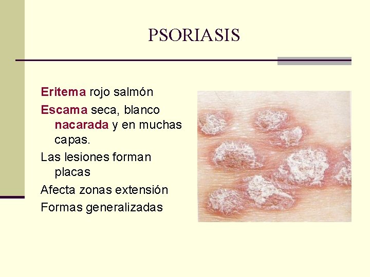 PSORIASIS Eritema rojo salmón Escama seca, blanco nacarada y en muchas capas. Las lesiones PSORIASIS Eritema rojo salmón Escama seca, blanco nacarada y en muchas capas. Las lesiones