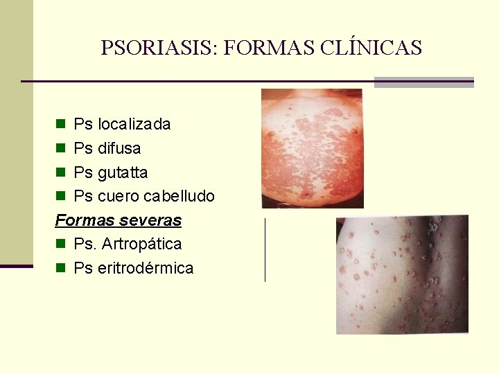 PSORIASIS: FORMAS CLÍNICAS n Ps localizada n Ps difusa n Ps gutatta n Ps PSORIASIS: FORMAS CLÍNICAS n Ps localizada n Ps difusa n Ps gutatta n Ps