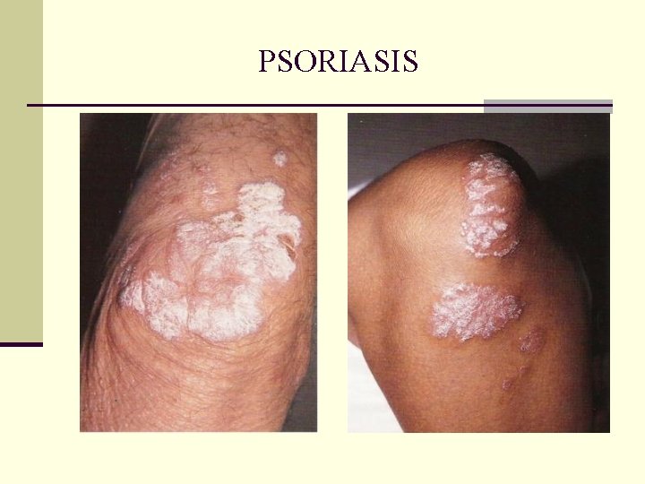PSORIASIS PSORIASIS
