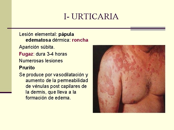 I- URTICARIA Lesión elemental: pápula edematosa dérmica: roncha Aparición súbita. Fugaz: dura 3 -4 I- URTICARIA Lesión elemental: pápula edematosa dérmica: roncha Aparición súbita. Fugaz: dura 3 -4